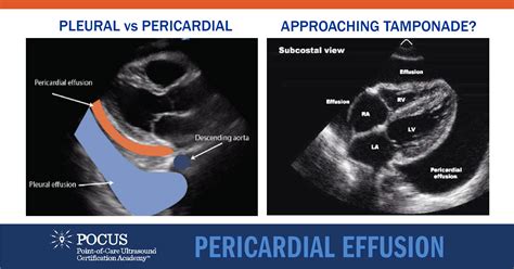 Pericardial Effusion Ultrasound