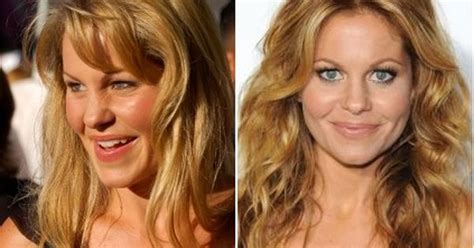 Candace Cameron Plastic Surgery Before And After