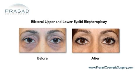Eye Lift Before And After Photos Eyelid Surgery Dr Prasad