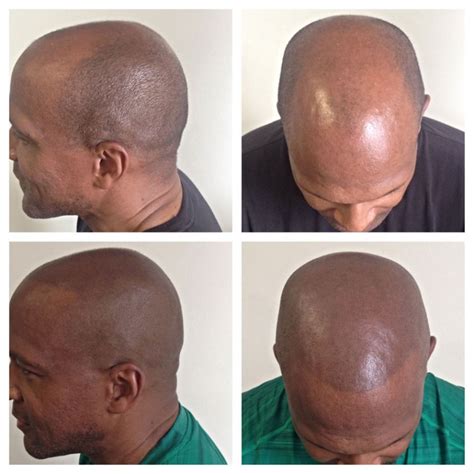 When To Get A Scalp Tattoo Or Smp Scalp Micropigmentation Treatment For
