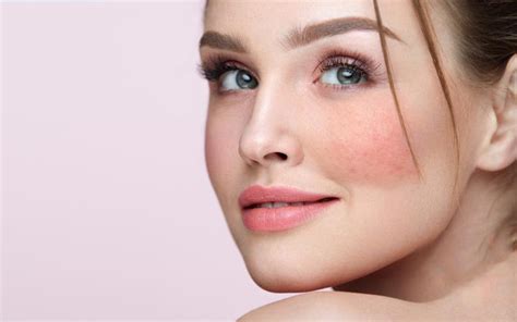 How To Manage Your Skin If You Have Rosacea