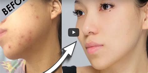 How To Heal Acne Scars Naturally How To Fade Post Acne