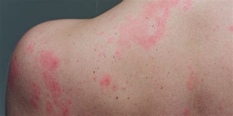 Skin Rashes And Diseases