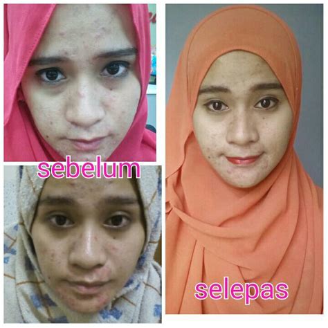 Salah satu bahan alami yang bisa anda gunakan untuk menghilangkan jerawat adalah lidah buaya. BETULKAH STRESS SEBAB UTAMA JERAWAT BERLAKU? | Jom Tampil ...