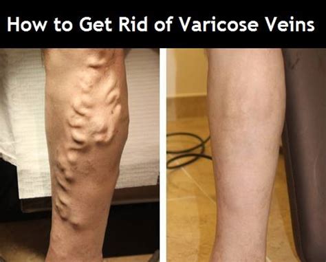 How To Get Rid Of Varicose Veins Vegetarian Friend