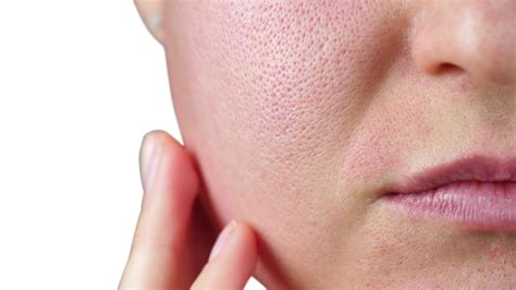 Enlarged Pore Treatment Wimbledon And Kensington Skin Clinics
