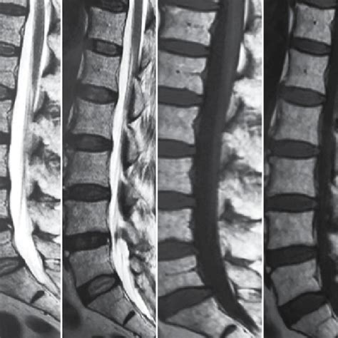 Mri In T1 And T2 Phases With Evidence Of Bilateral Facet Hypertrophy