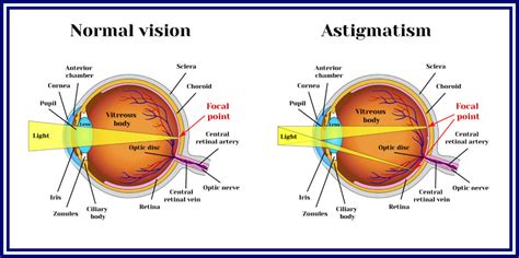 Astigmatism Causes And Correction