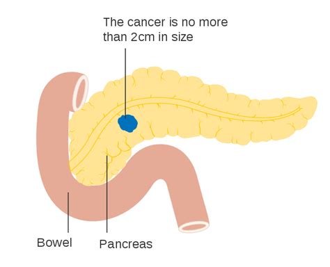 Pancreatic Cancer Wikipedia