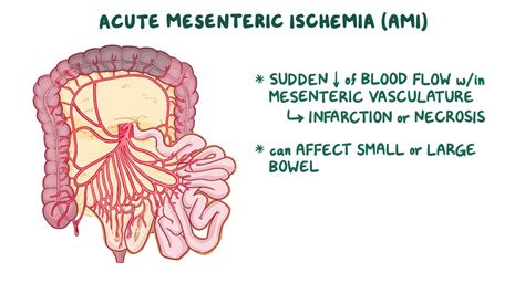 Acute Mesenteric Ischemia Clinical Sciences Osmosis Video Library