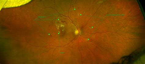 Critical Eye Conditions Found Using Optomap Walker And Campbell
