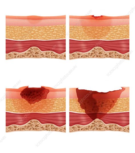Bed Sores Stock Image C0123612 Science Photo Library
