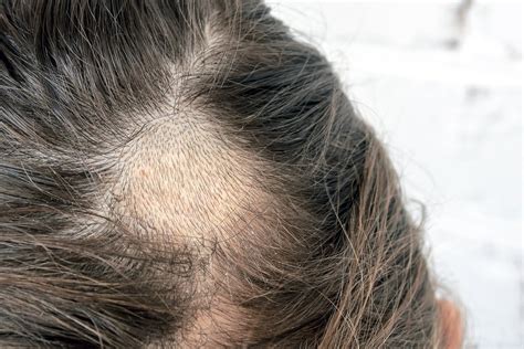 Tinea Capitis What It Is Symptoms Causes And Treatment
