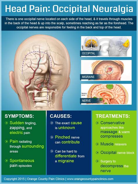 Head Pain Occipital Neuralgia By Orange County Pain Clinics Occipital