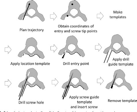 Multistep Pedicle Screw Insertion Procedure With Patient Specific Lamina Fit And Lock Templates