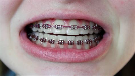 This allows the tongue to make a solid connection to the roof of their mouth, and for speech to flow correctly. BRACES Q&A (Rubber bands, Pain, Tips) - YouTube