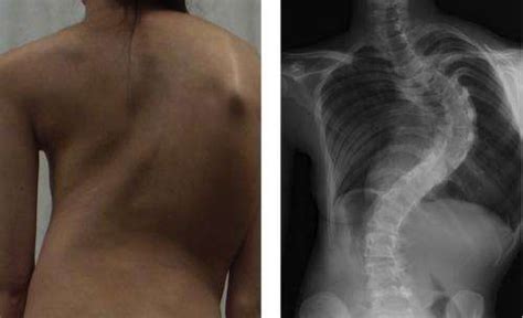 Gene Associated With Adolescent Idiopathic Scoliosis Identified