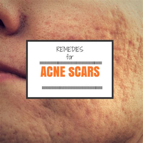 It contains natural humectant which helps to hydrate and the turmeric lightens up the scars. 5 Proven Home Remedies for Acne Scars (That Work)