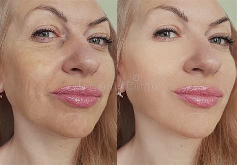 Woman Face Wrinkles Removal Lift Difference Correction Before And After