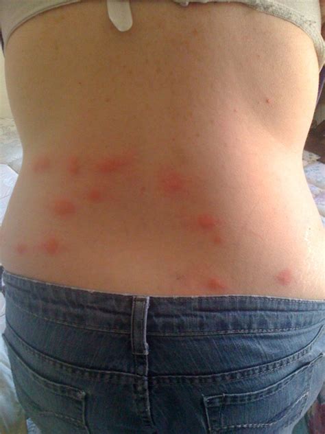 Bed Bugs Of Bites On Humans Bed Bugs Registrybed Bugs Registry