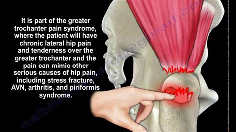 Can A Torn Gluteus Minimus Heal Itself All Answers Ecurrencythailand Com