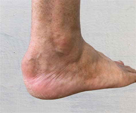 Pain On My Heel Sales Discounts Save 67 Jlcatjgobmx