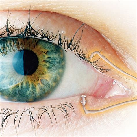 droge ogen oorzaak symptomen en behandeling ogenblik