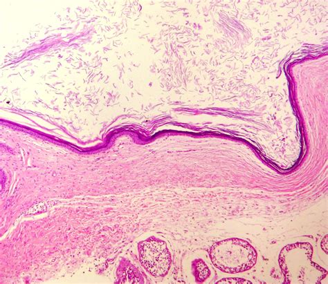 Uropatología En Línea Epidermoid Cyst Of The Testis Organ Preserving