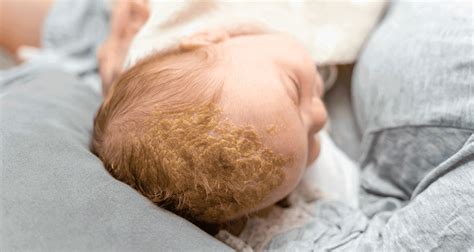 Cradle Cap Natural Remedies For Newborns And Toddlers