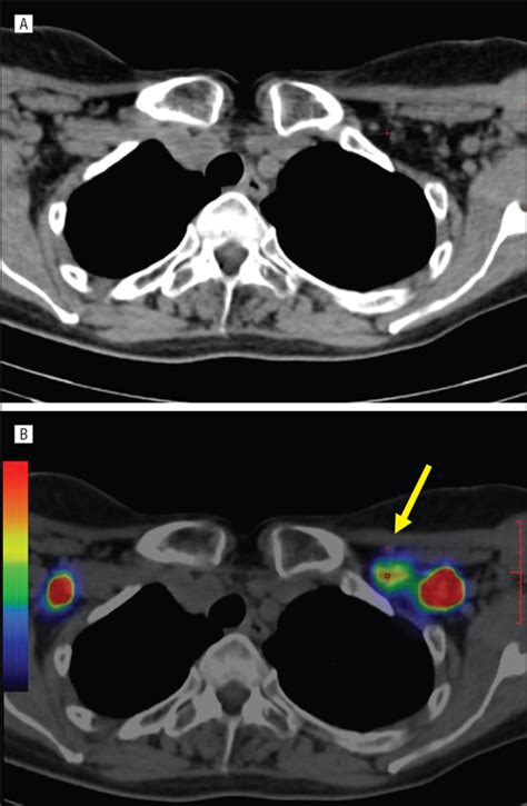 Recurrent Lymphangiectasia Of The Left Supraclavicular Fossa An