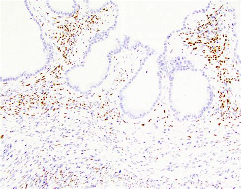 Pathology Outlines Mucinous Cystic Neoplasm