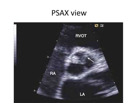 Echo Assessment Of Aortic Regurgitation Ppt