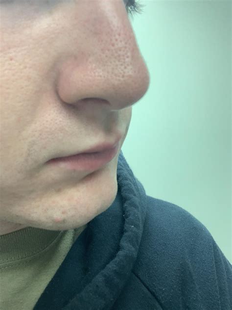 Help Large Pores Oily Nose Rosacea