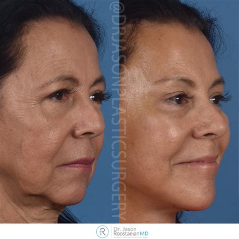 Dr Jasons One Week Brow Neck And Facelift Results Natural Looking