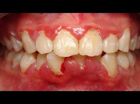 It emerges during the night that gives you the swelling, irritation, and the pricking pain while you are asleep. 3 Easy Ways to Get Rid Of Gum Swelling | How to Get Rid Of ...