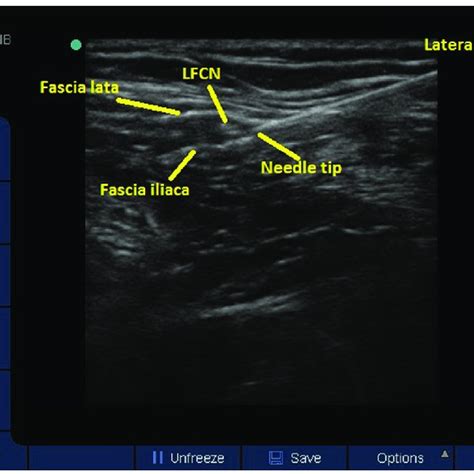 Lateral Femoral Cutaneous Nerve Origin