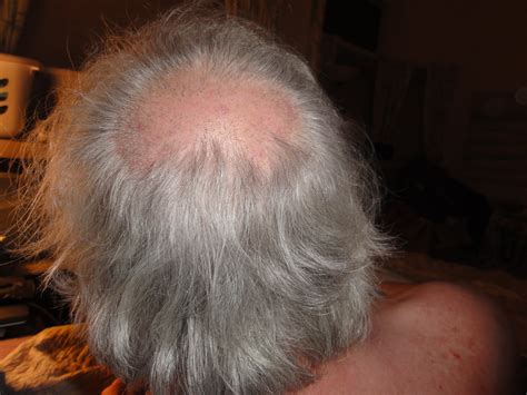 A hot spot on your cat (or even on your dog) will look like an area of fur that is missing. bald spots on head pictures - DriverLayer Search Engine
