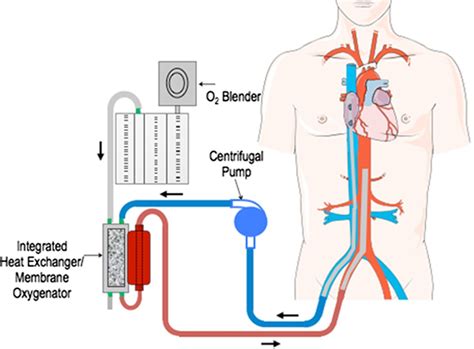 See the best & latest ecmo circuit change cpt code on iscoupon.com. Successful cardiac resuscitation with extracorporeal ...