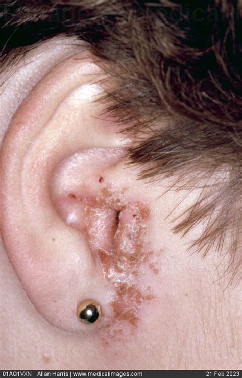 Stock Image Dermatology Fungal Otitis Externa Crusty And Peeling Skin
