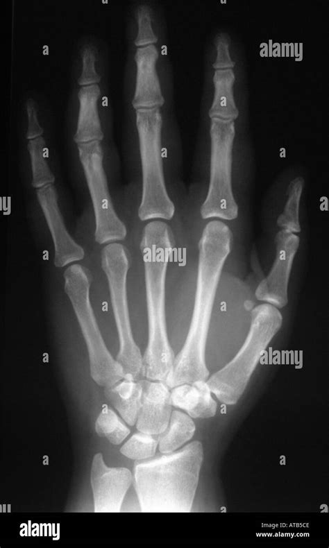 X Ray Normal Hand Stock Photo Alamy