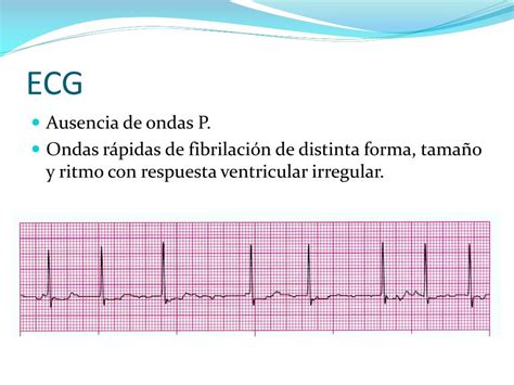 Ppt FibrilaciÓn Auricular Powerpoint Presentation Free Download Id