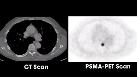 Highly Sensitive New Type Of Prostate Cancer Scan Gains Fda Approval