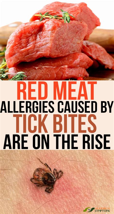 Red Meat Allergies Caused By Tick Bites Are On The Rise Allergy Symptoms