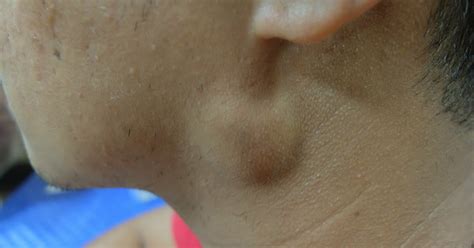 Fistula Branquial No Pescoço