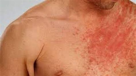 Cutaneous Candidiasis Exams And Tests Health Digest