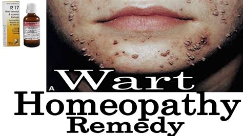 Warts Discussion And Remedy In Homeopathy By Dr Ps Tiwari Youtube