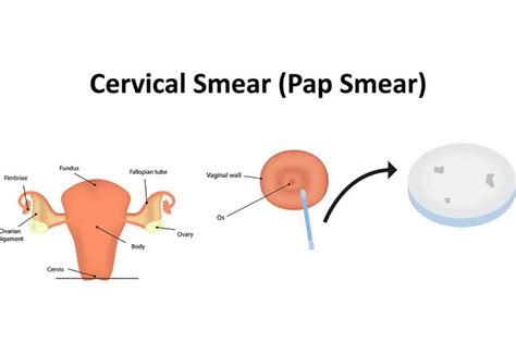 Pap Smear Test During Pregnancy Need Safety Risks Associated