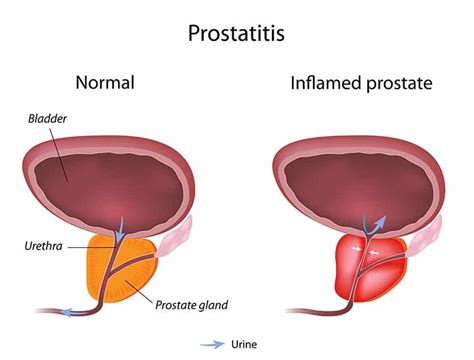 Signs Symptoms Causes Of Prostatitis In Men