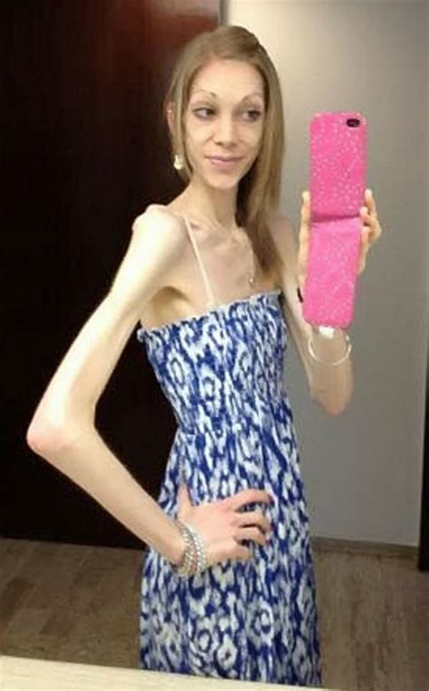 amazing transformation of anorexic who fought back from brink of death to become a champion