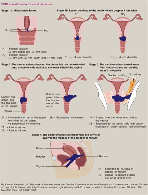 Invasive Cervical Cancer Obstetrics Gynaecology And Reproductive